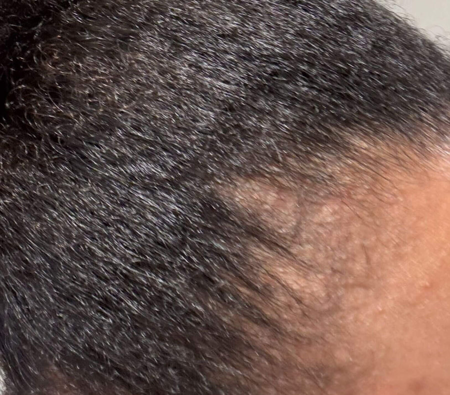 Before using Froday duo showing dry edges and thinning along hairline